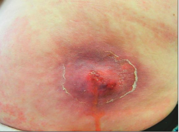 Из карбункула вытекает гной [4]