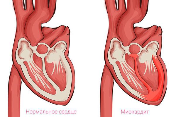 Миокардит — воспаление сердечной мышцы