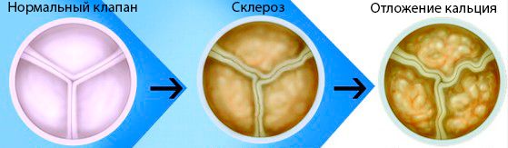 Склероз аортального клапана