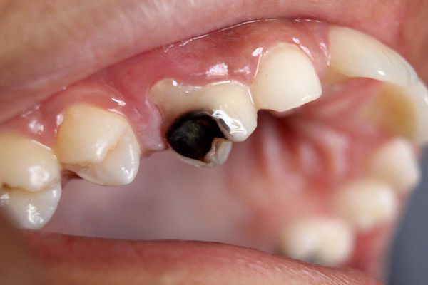 Кариозное поражение зуба