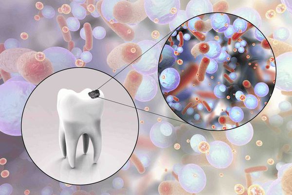 Участие микроорганизмов в деминерализации твёрдых тканей зуба