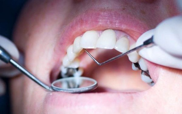 Зондирование зубов