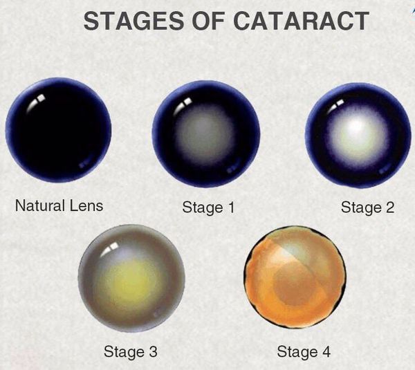 stadii razvitiya katarakty s