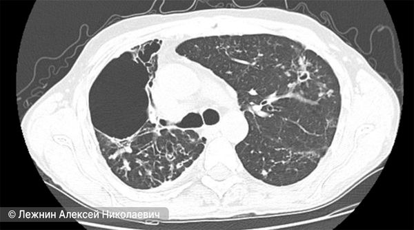 Состояние лёгкого через 10 месяцев после лечения