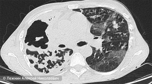 Состояние лёгкого через 2 месяца после эффективного антибактериального лечения