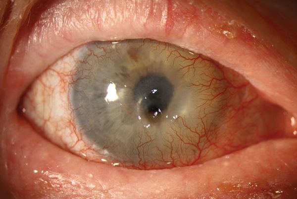 Десцеметоцеле [23]