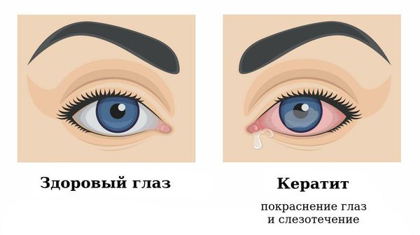 Здоровый глаз и кератит
