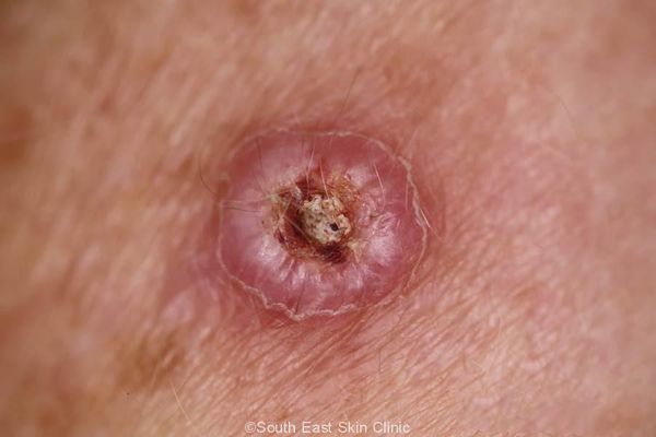 Как выглядит кератоакантома [15]