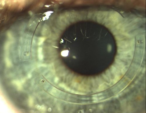 Глаз с имплантированным роговичным сегментом