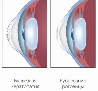 Пузырьки и рубцы на роговице