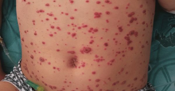 Геморрагическая сыпь [18]