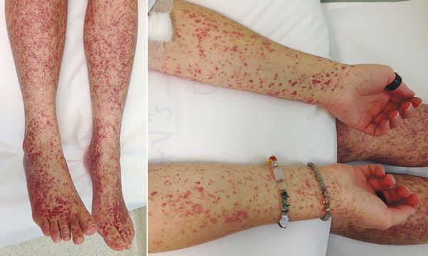 Сыпь при кишечном иерсиниозе [17]