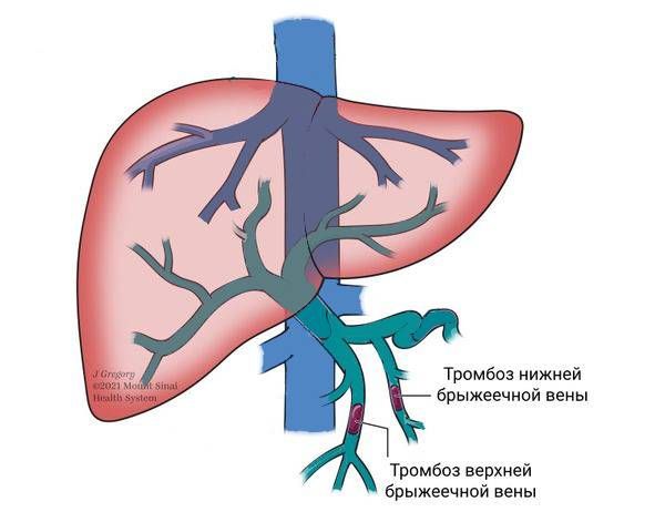 Тромбоз брыжеечных вен