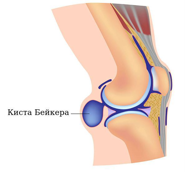 Ушиб колена лечение