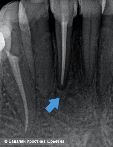 Через 2 года костная ткань вокруг корня нижнего резца полностью восстановилась без хирургического вмешательства