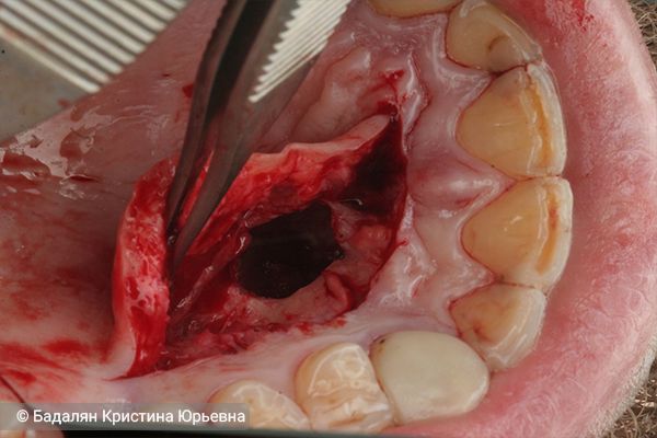 Дефект в челюстной кости после цистэктомии