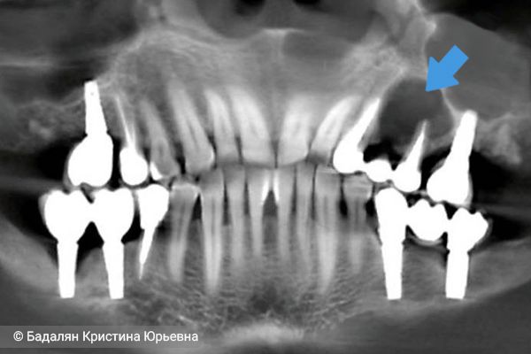 Киста челюсти на ортопантомограмме