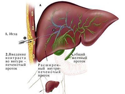 Чрезпеченочная холангиография Чрезпеченочная холангиография