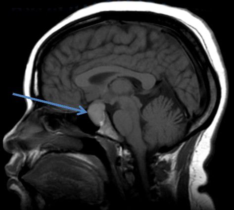 Киста кармана Ратке [24]
