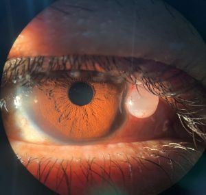 Перилимбическая конъюнктивальная инклюзионная киста [1]