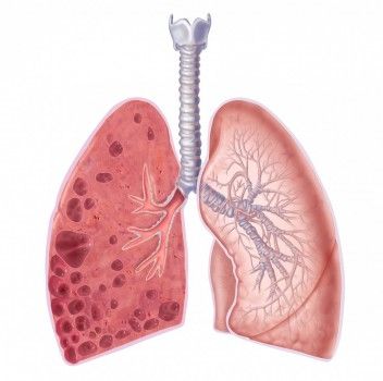 Редкие заболевания легких и дыхательной системы