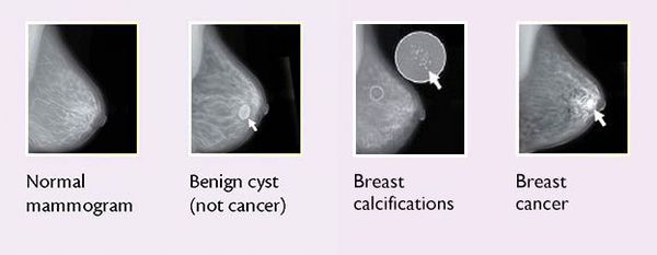 mammogramma s