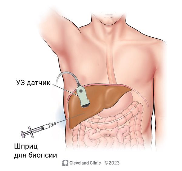 Биопсия печени