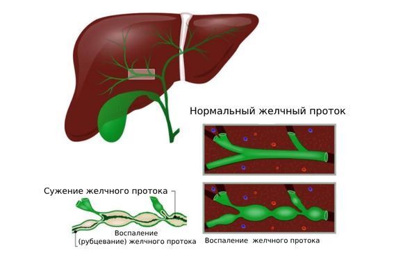 Киста печени - причины, симптомы, признаки, диагностика, лечение, диета