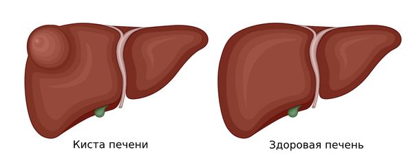 Киста почки