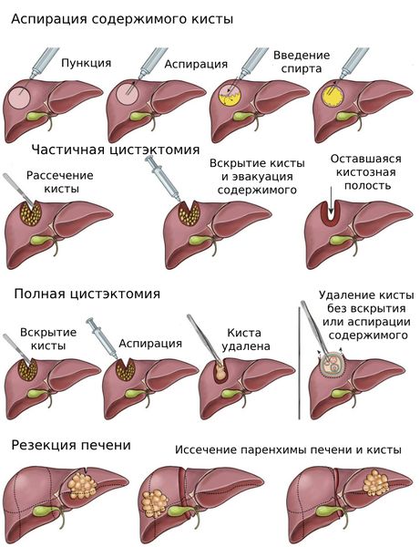 Киста печени - лечение - операции по методу К.В. Пучкова - Хирург К. В. Пучков