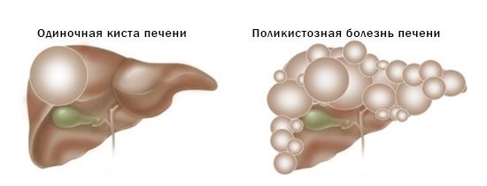 Виды кист печени