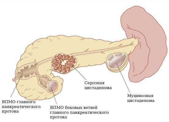 Кистозные опухоли поджелудочной железы