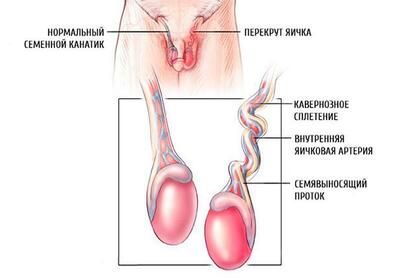 Перекрут семенного канатика