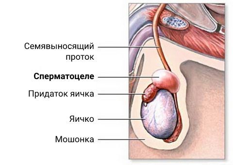 Сперматоцеле