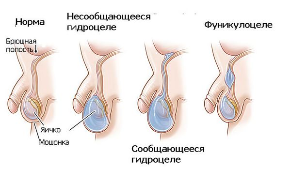 Типы патологий при незаращении влагалищного отростка