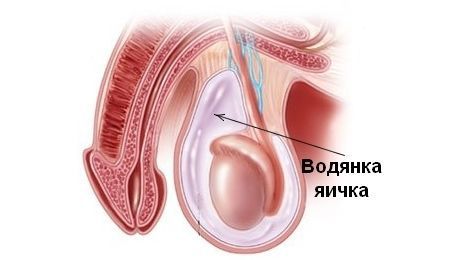 Водянка яичка