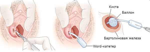 Что такое киста влагалища: причины, симптомы, лечение — блог клиники Platinum Laser