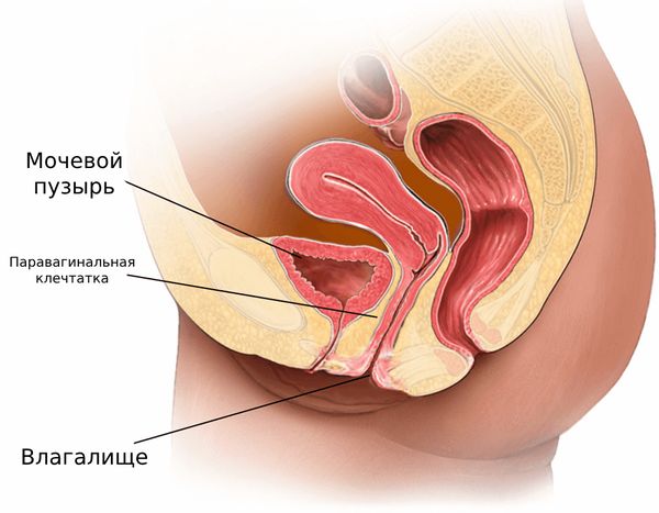 Киста влагалища. вскрытие и удаление