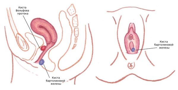 Что такое киста влагалища?