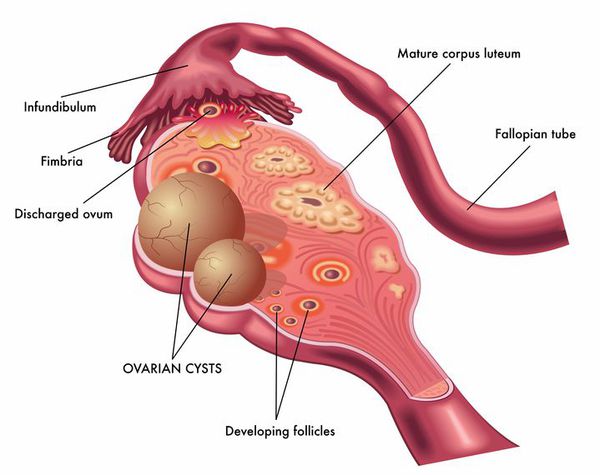 Анатомия яичника с развившимися в ней кистами
