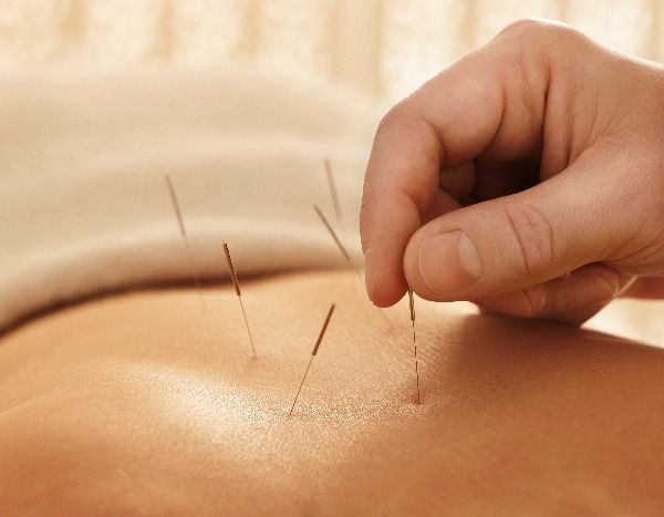 akupunktura s
