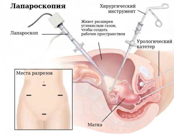 laparoskopiya s
