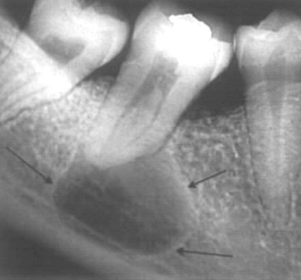 Радикулярная киста на рентгенограмме [21]