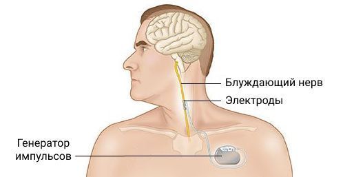 Стимуляция блуждающего нерва Стимуляция блуждающего нерва