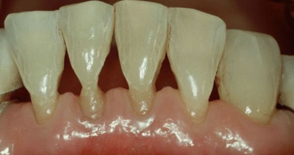 Повреждение твёрдых тканей зубов в области шейки