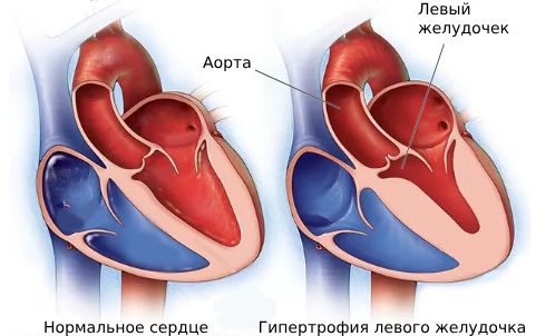 Гипертрофия миокарда левого желудочка
