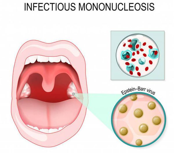 infekcionnyy mononukleoz s