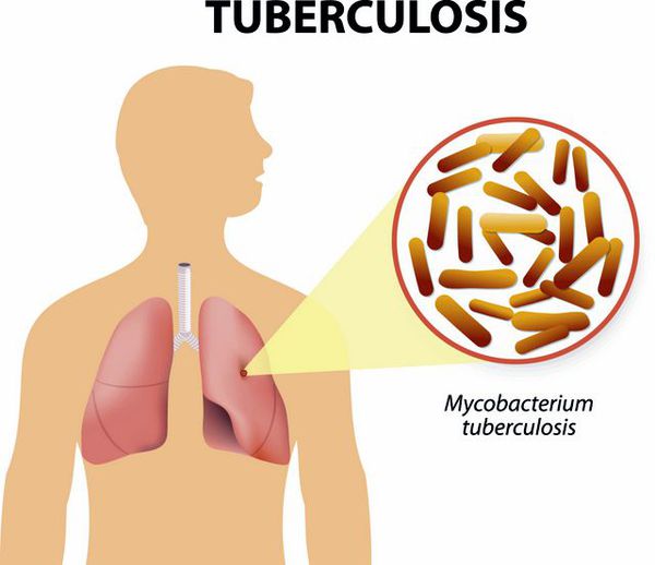 tuberkulyoz s