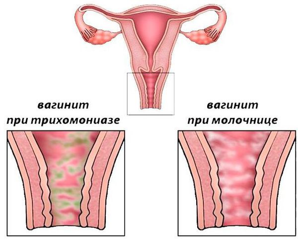 Трихомонадный и кандидозный вагинит