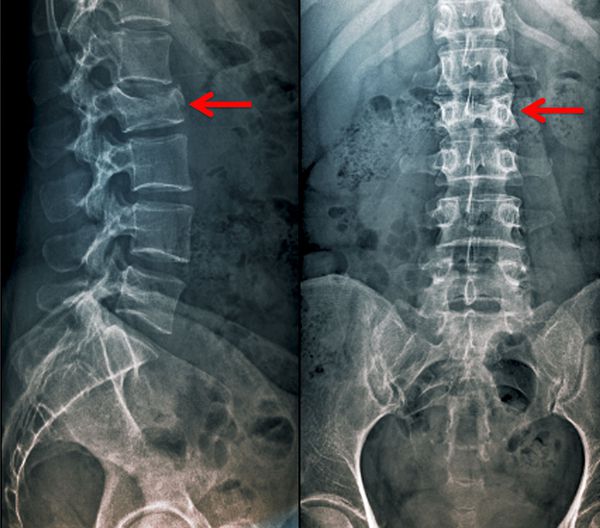 Компрессионный перелом позвоночника на рентген-снимке